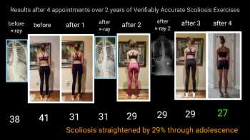 Scoliosis Gym